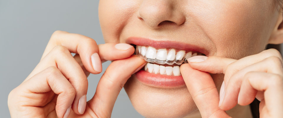 A young woman does a home teeth whitening procedure. Whitening tray with gel