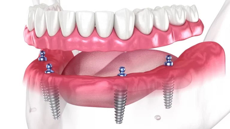 Prothese sur implants