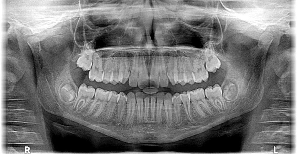 Radiographie dentaire casablanca